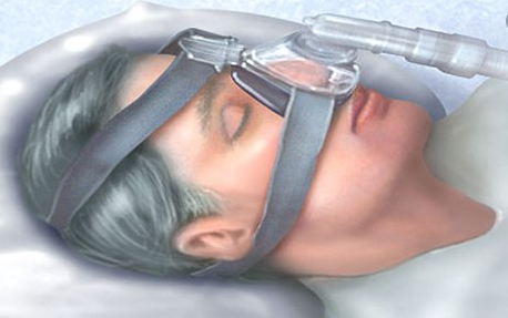 Thở áp lực dương liên tục (CPAP)
