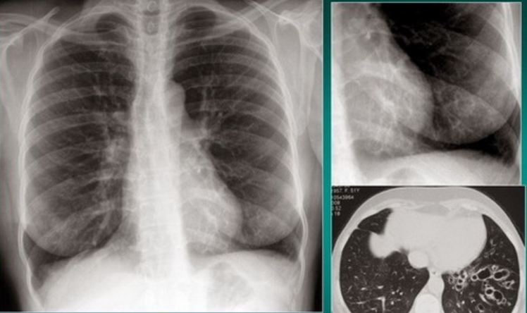 Giãn phế quản khu trú LIG