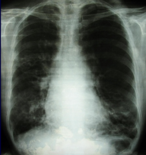 giãn phế quản trên x quang