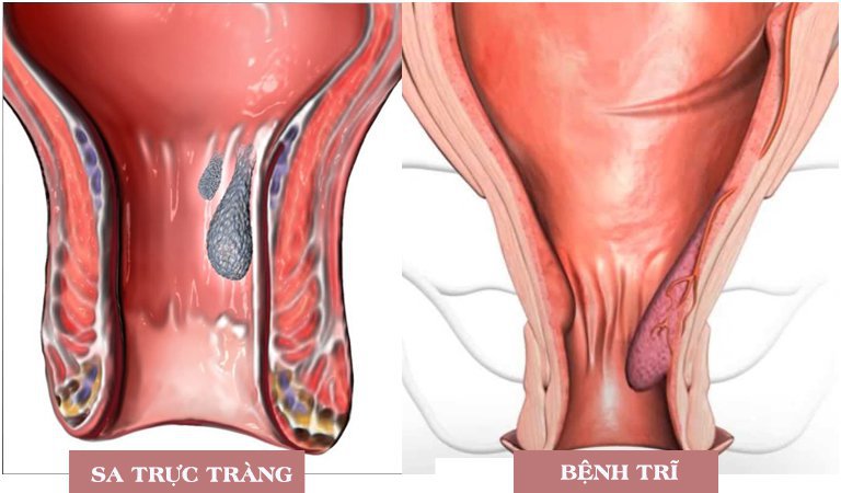 Điều trị sa trực tràng bằng mổ nội soi - ảnh 3