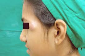 U thượng bì vôi hoá