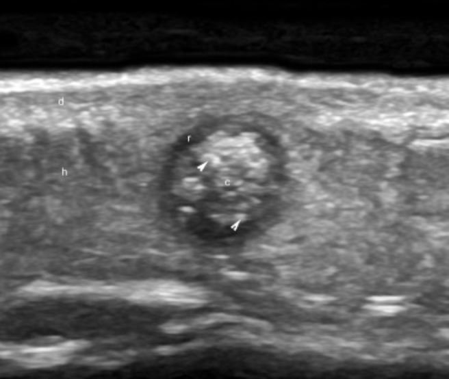 Hình ảnh U thượng bì vôi hóa (pilomatrixoma) trên siêu âm