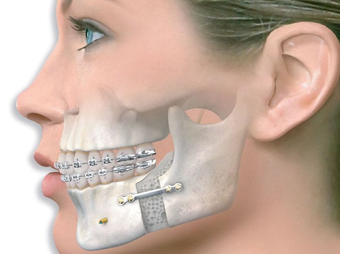 Quy trình chụp cắt lớp vi tính hàm mặt không tiêm thuốc đối quang theo mặt phẳng axia - ảnh 1