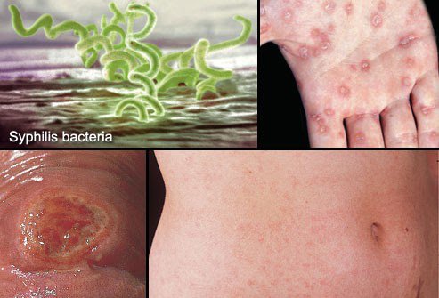 Hình ảnh và thông tin về bệnh lây qua đường tình dục (STDs)