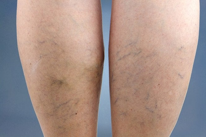 Một số chú ý về bệnh lý suy tĩnh mạch chi dưới - ảnh 1
