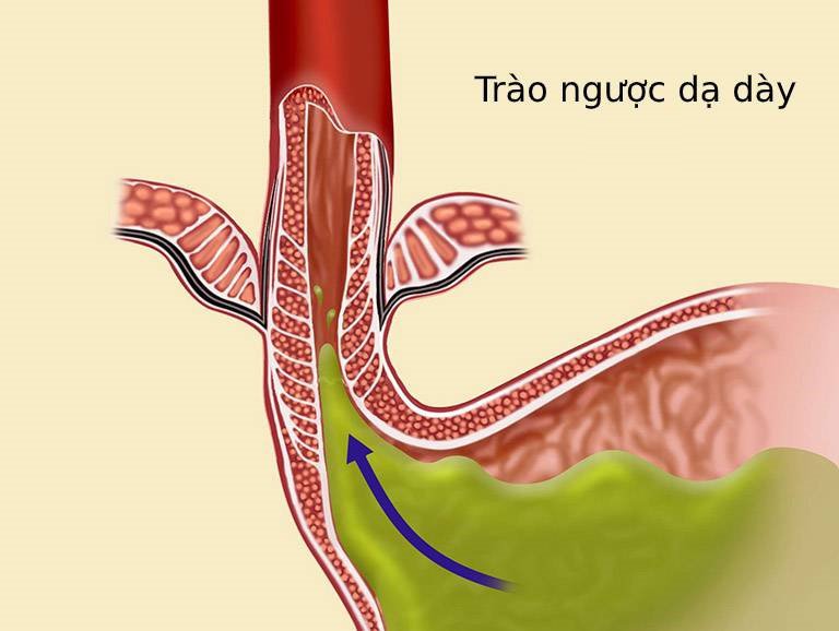 Gây mê nội khí quản phẫu thuật cắt u buồng trứng hoặc bóc u buồng trứng - ảnh 5