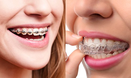 Khi nào cần chụp x quang răng khôn? - ảnh 2