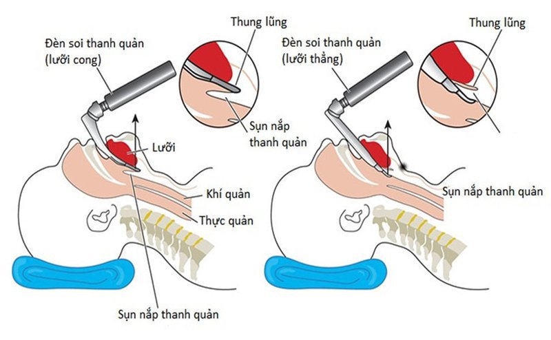 Kỹ thuật đặt nội khí quản qua đường miệng