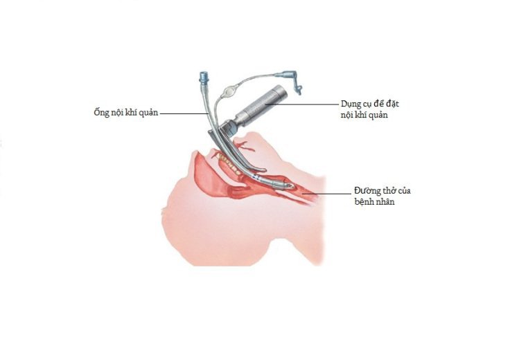Đặt nội khí quản khi dẫn mê là lựa chọn phổ biến