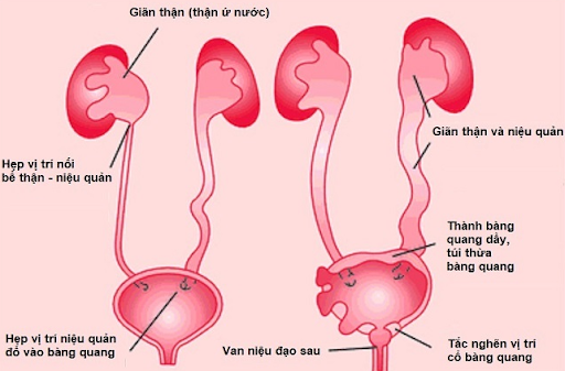Bàng quang to thai nhi - Megacystis - ảnh 2
