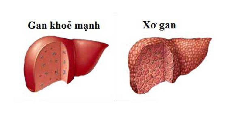 Nguyên nhân khiến người cao tuổi dễ mắc gan nhiễm mỡ - ảnh 1