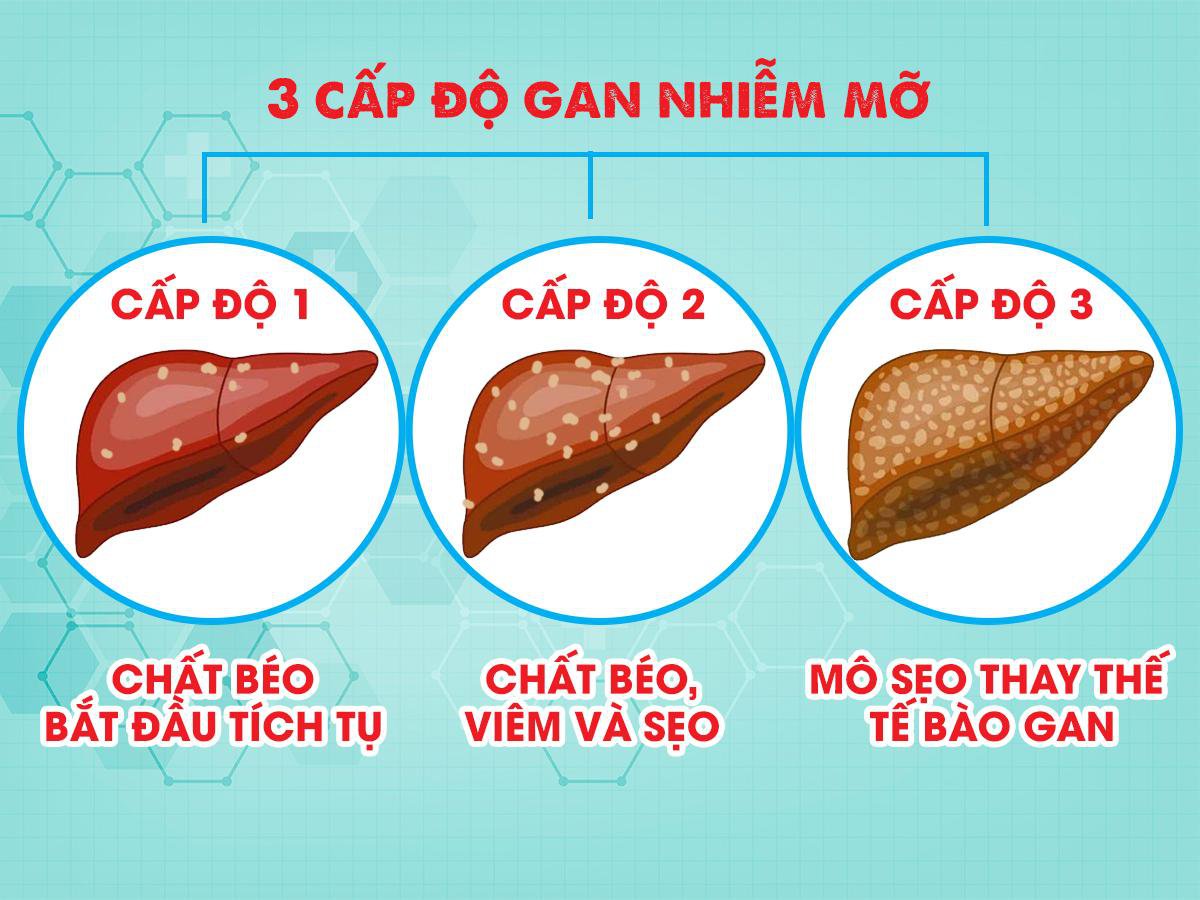 Gan nhiễm mỡ độ mấy là nặng? Điều trị như thế nào - ảnh 2