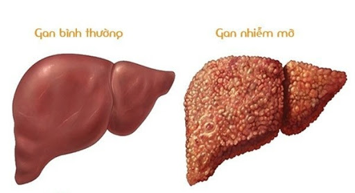 Gan nhiễm mỡ độ mấy là nặng? Điều trị như thế nào - ảnh 4
