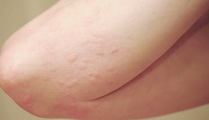 Nội soi phế quản sinh thiết: Những điều cần biết - ảnh 1