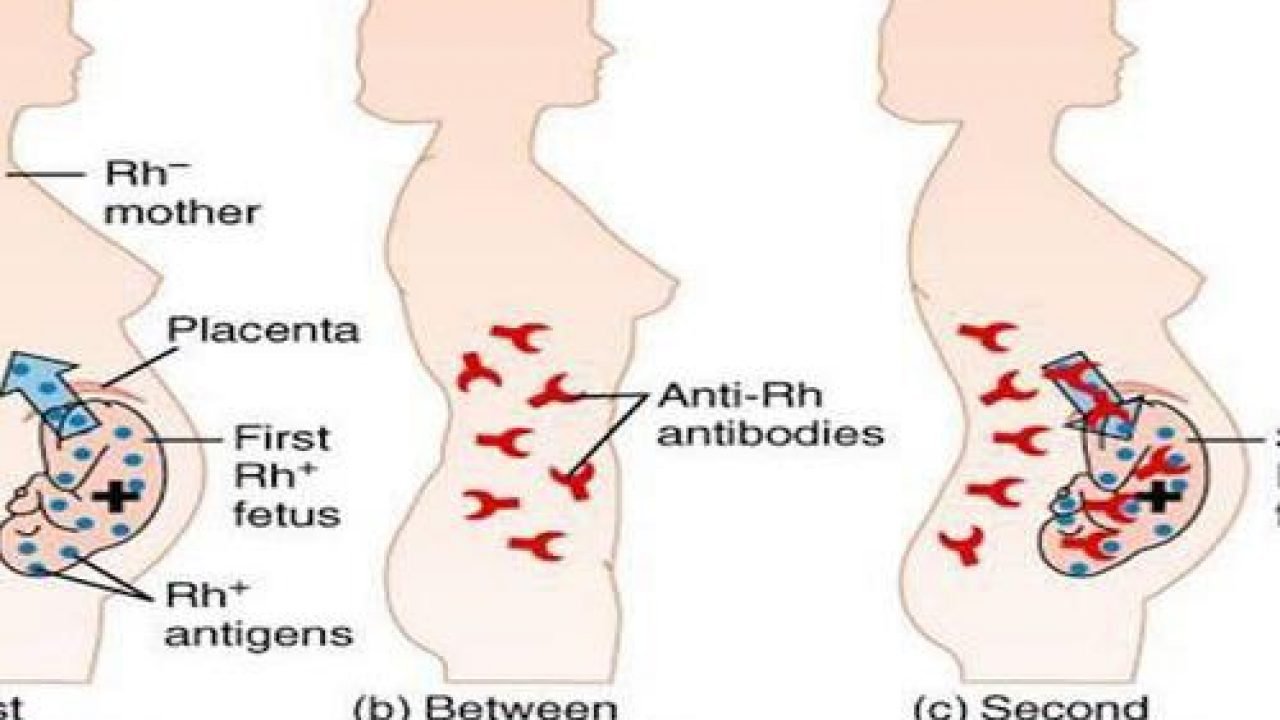 Bệnh vàng da huyết tán miễn dịch sơ sinh - ảnh 1