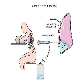 Các bước thực hiện chọc dịch màng phổi cấp cứu - ảnh 3