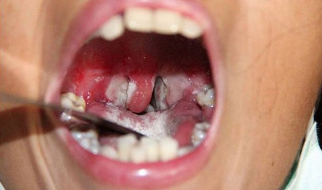 bạch hầu thanh quản