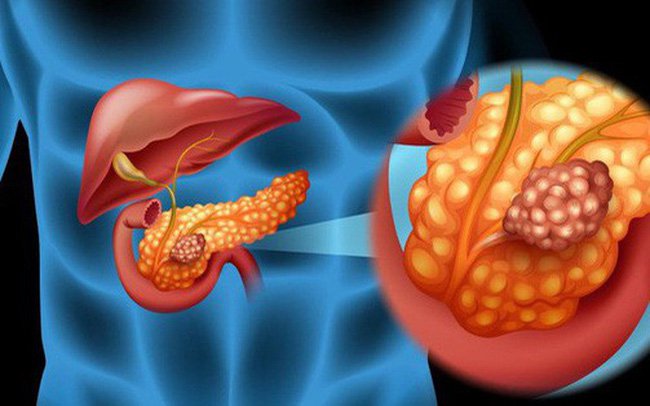 Các yếu tố nguy cơ của ung thư tụy - ảnh 1