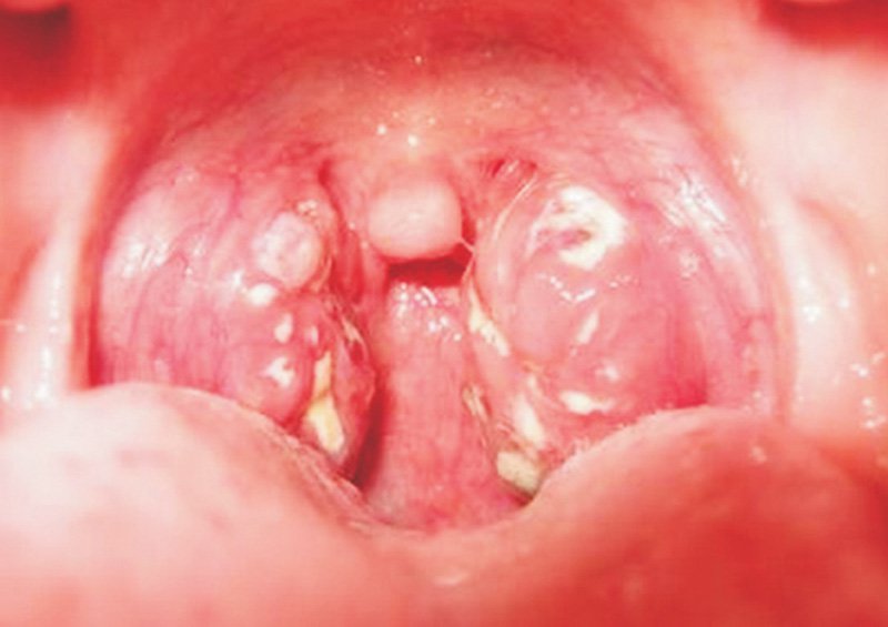 Những điều cần biết về bệnh bạch hầu và vắc-xin phòng bệnh - ảnh 1