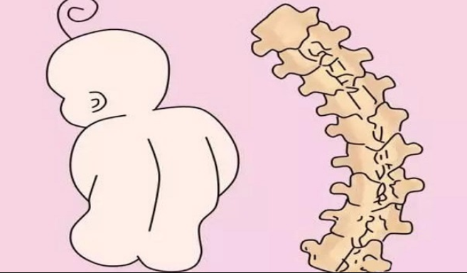 Phục hồi chức năng cho bệnh nhân vẹo cột sống - ảnh 1