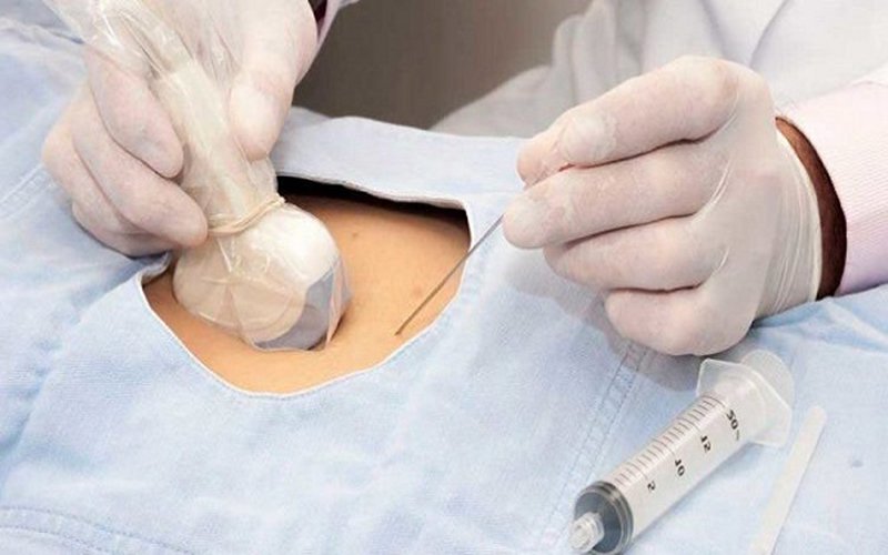 Chọc ối dưới hướng dẫn của siêu âm - ảnh 2