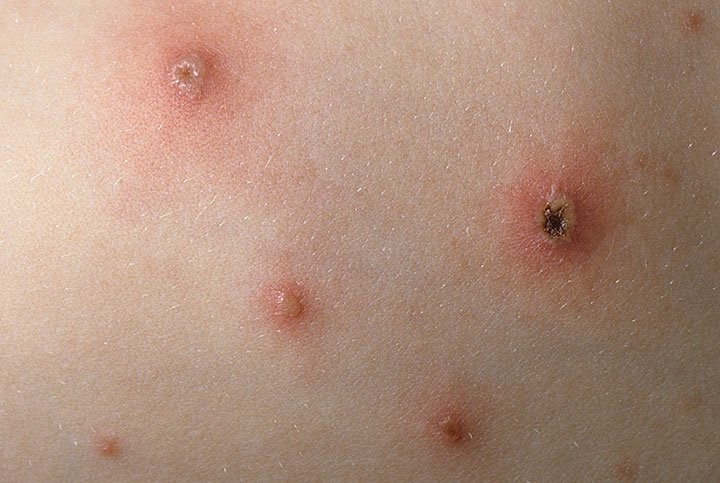 Các tình huống đặc biệt khi tiêm vắc-xin ngừa thủy đậu - ảnh 1
