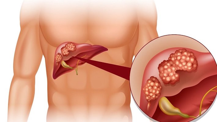 Bệnh viêm gan C là gì? Vì sao tôi có thể mắc bệnh này? - ảnh 1