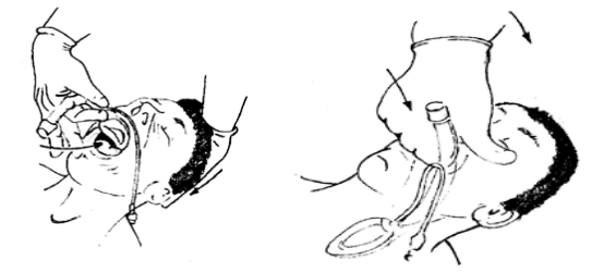 Gây mê mask thanh quản phẫu thuật nội soi xẻ sa lồi lỗ niệu quản - ảnh 2
