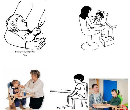 Rối loạn nuốt ở trẻ bại não - ảnh 2