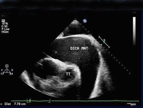 Siêu âm Doppler đánh giá biến chứng sau nhồi máu cơ tim - ảnh 2