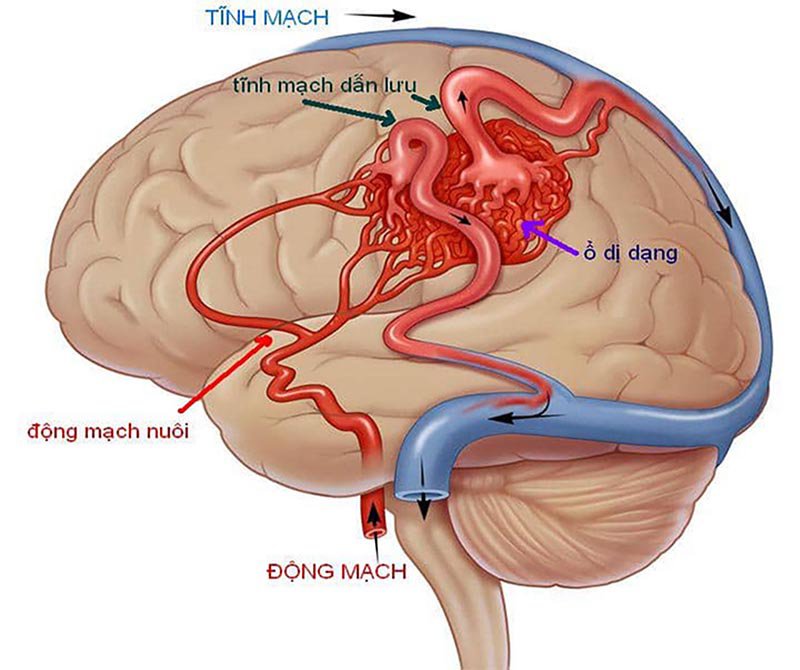 Xạ phẫu SRS trong điều trị sang thương hệ thần kinh trung ương - ảnh 1
