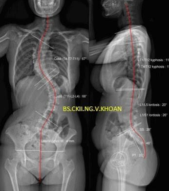 vẹo cột sống vô căn tuổi thành niên