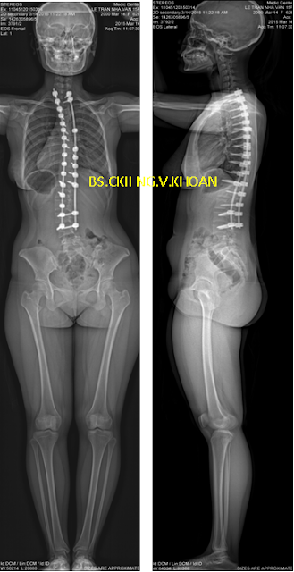 Hình X quang EOS sau mổ