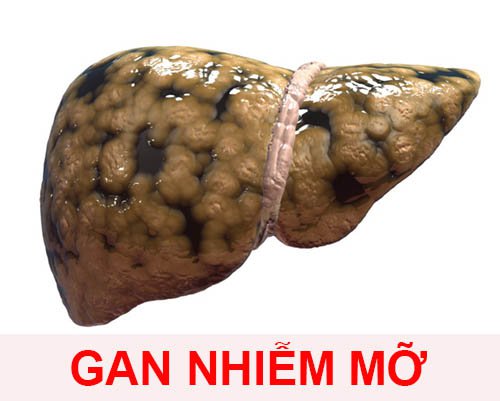 Gan nhiễm mỡ có mấy loại?