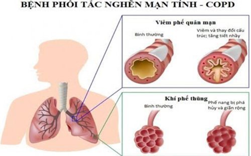 phổi tắc nghẽn mạn tính