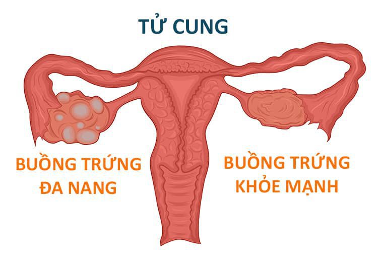 Phẫu thuật nội soi đốt điểm buồng trứng điều trị buồng trứng đa nang