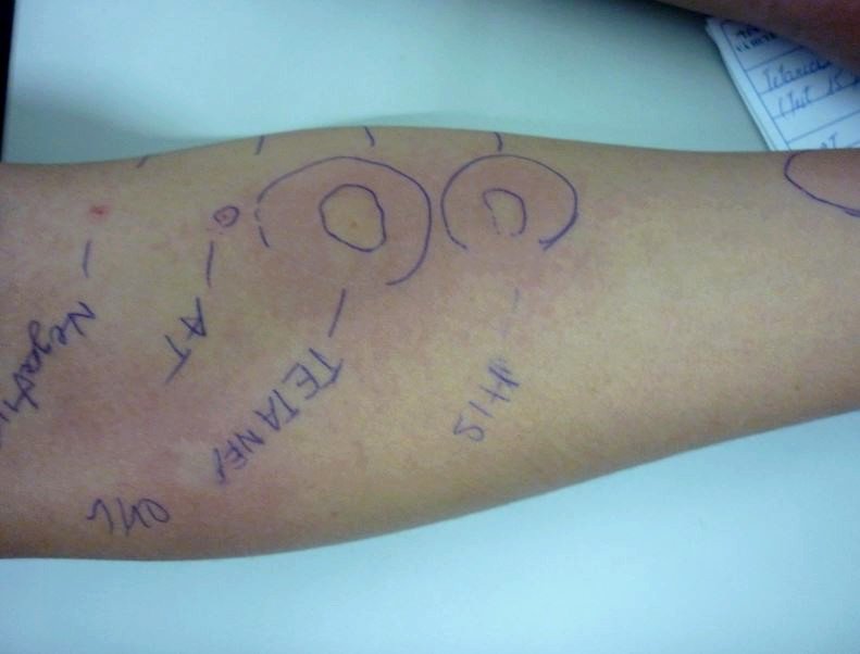 Test lẩy da dương tính với vắc-xin phong uốn ván