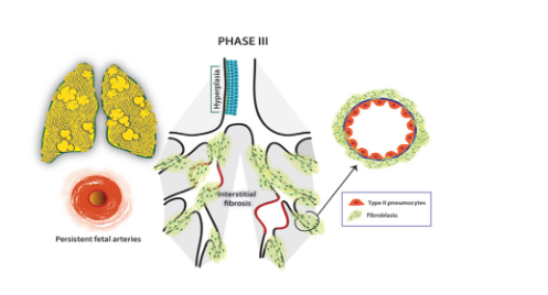 Giai đoạn 3 của LSPQP