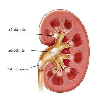 Sỏi thận