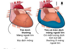 Tim có tràn dịch màng ngoài tim