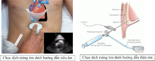 Chọc dịch màng ngoài tim