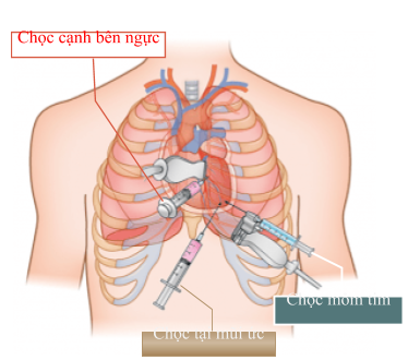 Vị trí chọc hút dịch màng tim
