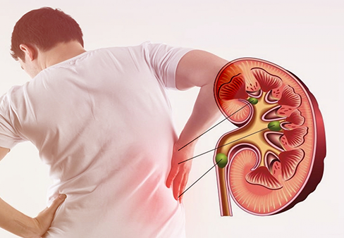 Bệnh nhân mắc sỏi thận được chỉ định chụp cắt lớp hệ tiết niệu có tiêm thuốc cản quang