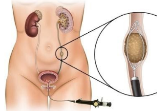 Tán sỏi nội soi ngược dòng