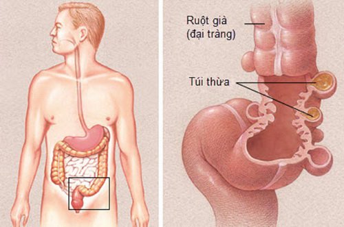 Viêm túi thừa đại tràng biến chứng