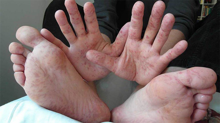 Nổi mẩn đỏ tay chân