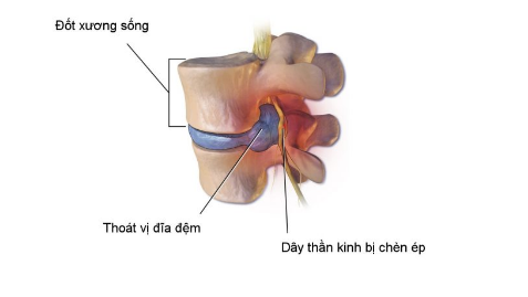 Thoát vị đĩa đệm