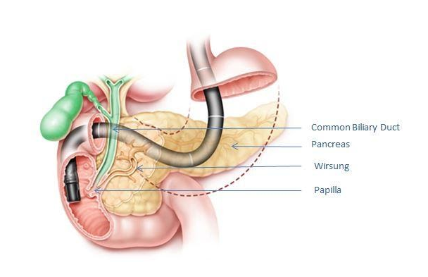 Hình 1. Hình ảnh minh họa kỹ thuật ERCP: Máy nội soi (màu đen); Nhú tá tràng (Papilla); Ống tụy chính (Wirsung); Ống mật chủ (Common Biliary Duct); Tụy (Pancreas).