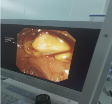 Hình 2. Ứng dụng ERCP lấy sỏi mật, tụy tại Bệnh viện Quốc tế VINMEC time city Hà Nội