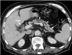 tụy teo và giãn ống tụy không đều
